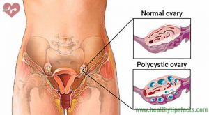 Ovarian disorders
