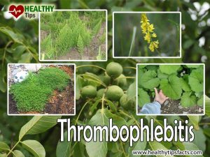 Thrombophlebitis